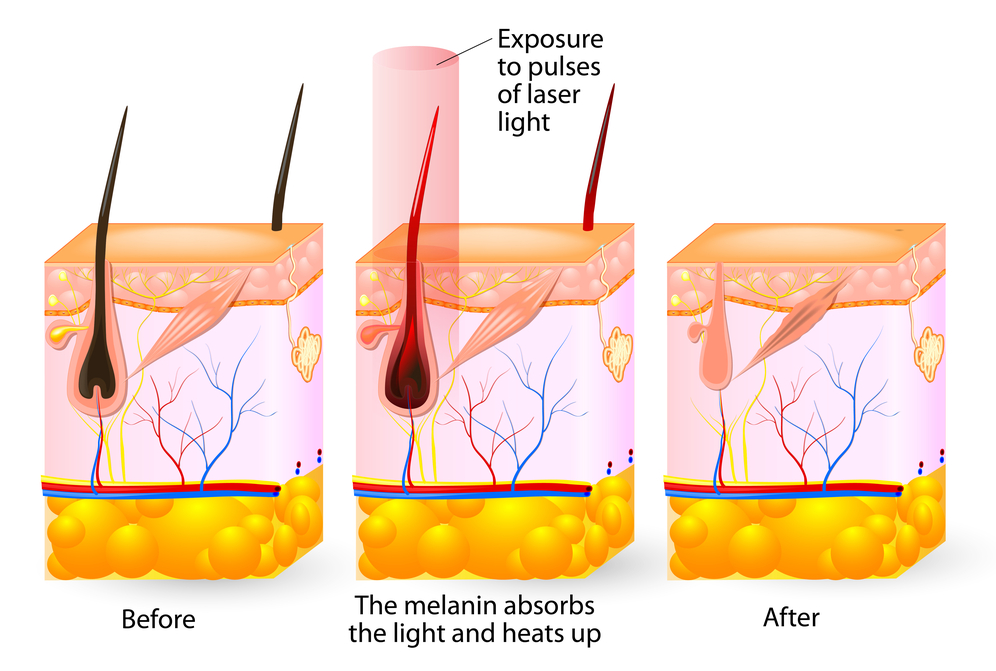 laser treatment