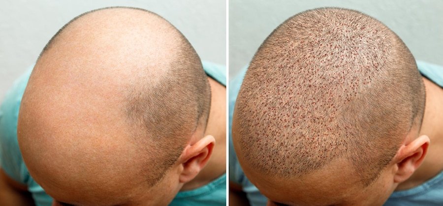 hair transplant specialist doctor in thane