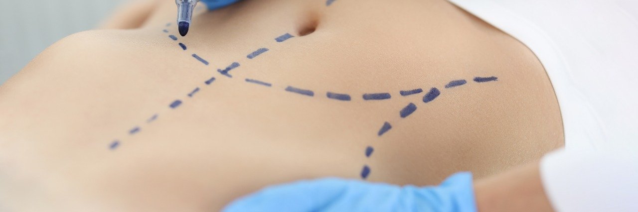 Liposuction Surgery in Thane